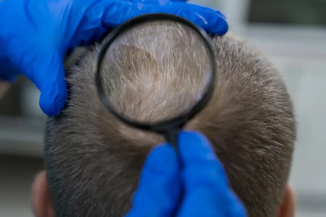 Exosomes Hair Treatment Birmingham, Wolverhampton, West Midlands