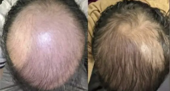 Hair loss before and after treatment results