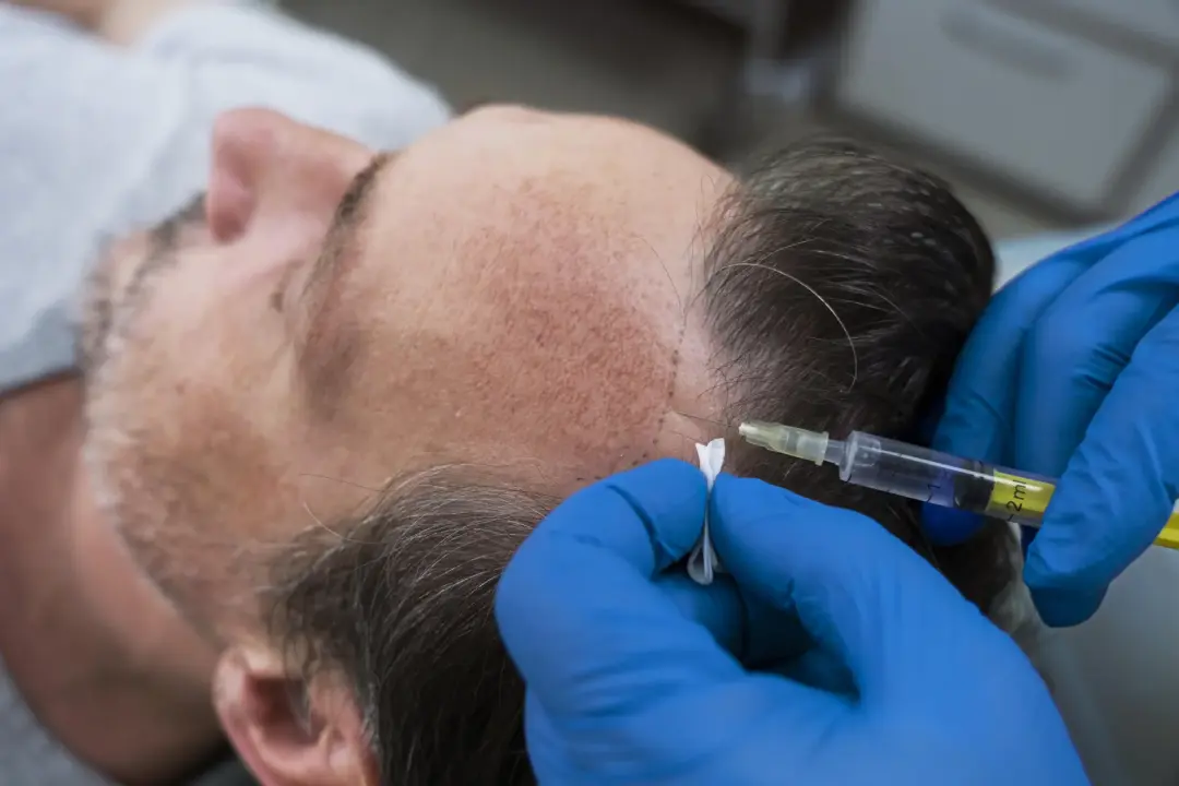 PRP Hair Loss Treatment Birmingham, Wolverhampton, West Midlands
